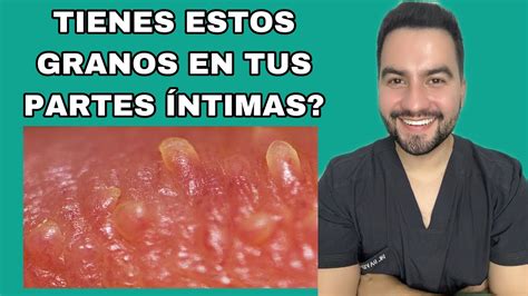 grano en el pene|Granos en el pene: 10 tipos ofensivos e inofensivos